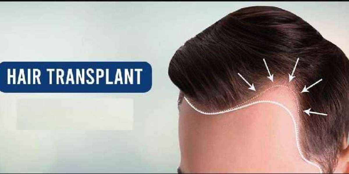 The Ultimate Guide to Hair Transplant in Bhilai: What to Expect