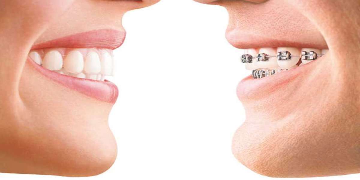 Oral Health with Invisalign: Tips and Tricks