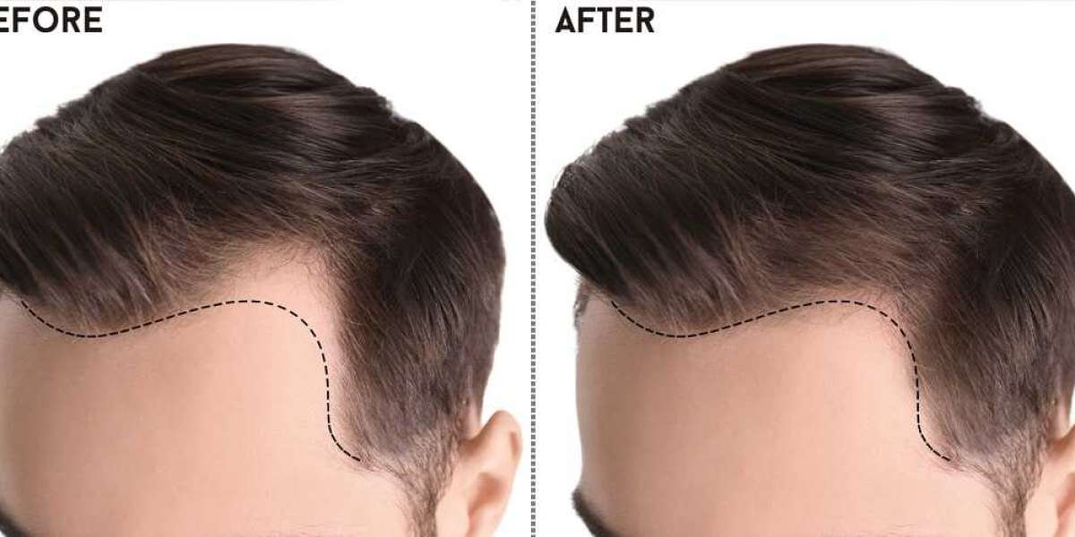 Mastering Excellence: The Ultimate Guide to the Best Hair Transplant in Pakistan